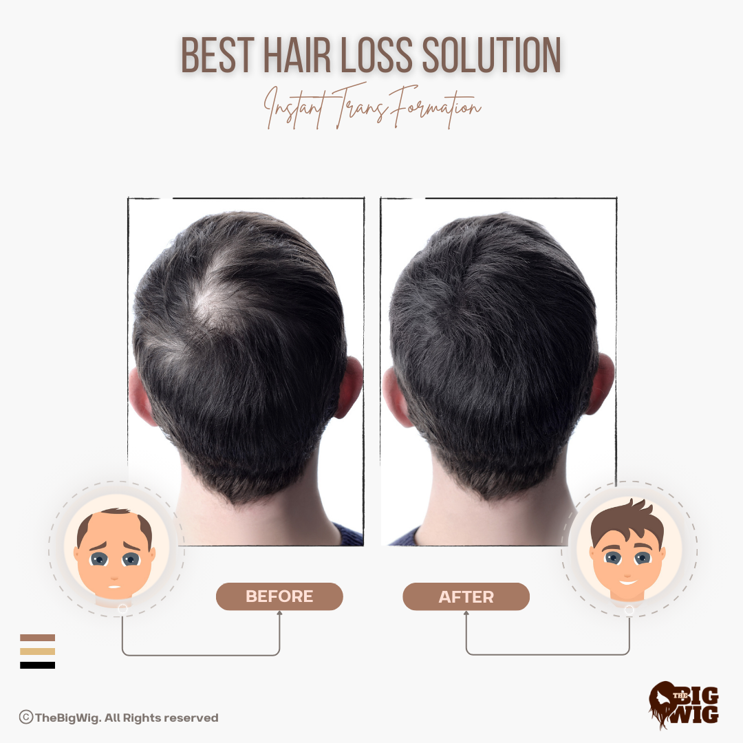 Alpha Monofilament Hair Patch – Superior Quality and Natural Appearance