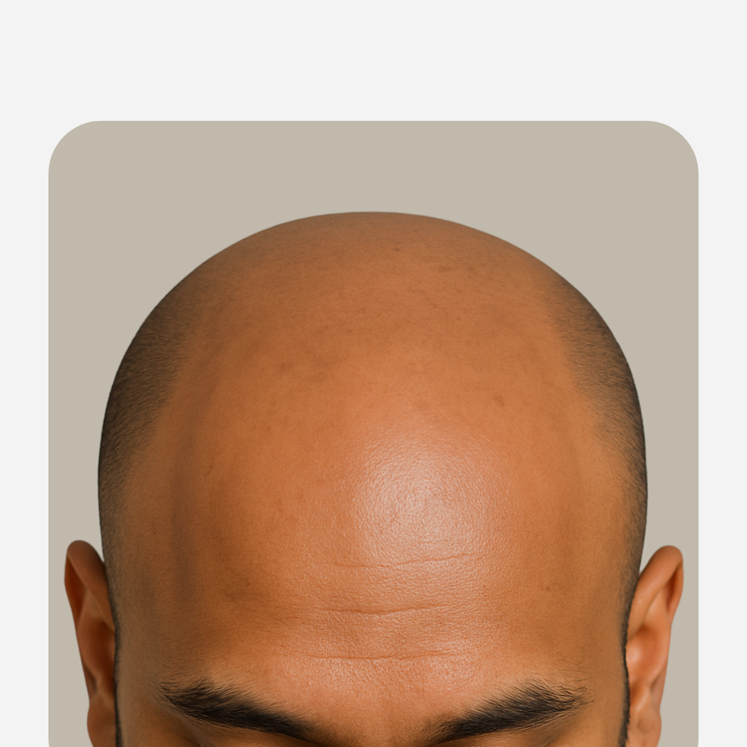 Full Head Wigs for Bald Men – 100% Human Hair | Natural Look & Total Coverage